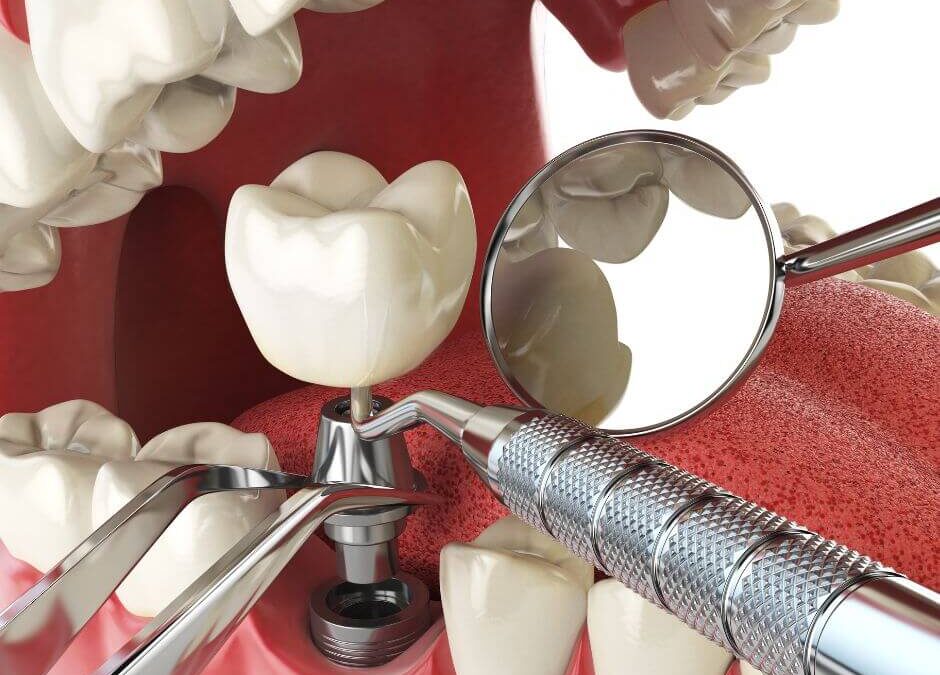 Cuidado de Implantes Dentales